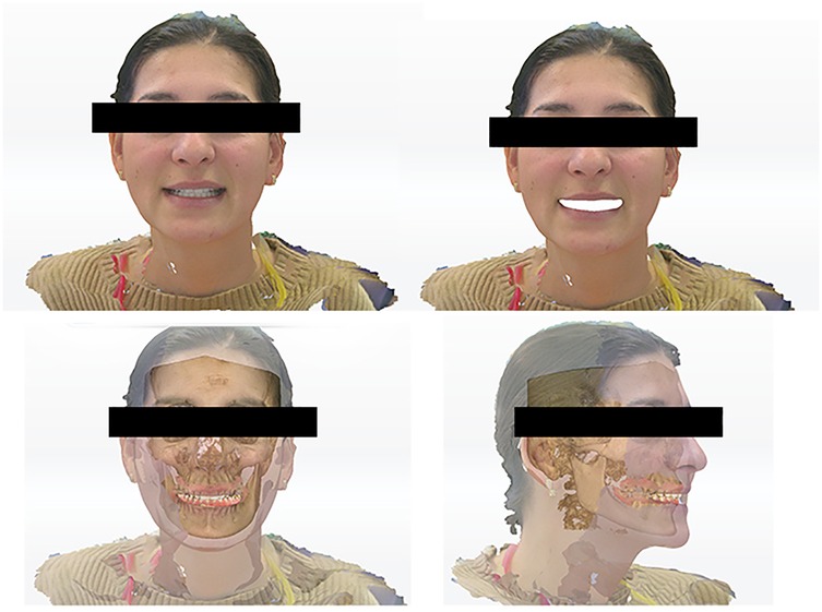 Four-part image showing a frontal and side view of a person's face. The eyes are blacked out for privacy. The top two images show an external view, while the bottom two show a skeletal overlay.