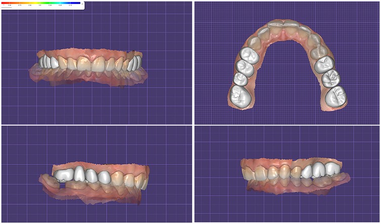 Digital dental model with four views on a blue grid background. Top-left: anterior view of teeth. Top-right: occlusal view of upper arch. Bottom-left: lateral view from the left. Bottom-right: lateral view from the right.