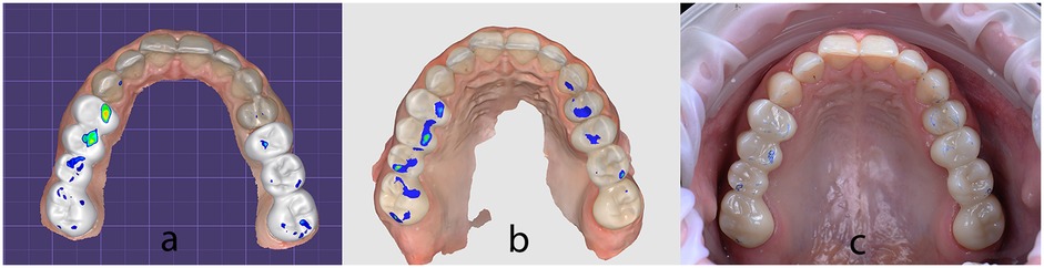 Three panels showing dental models. Panel a: A digital model with color markings on teeth indicating stress points. Panel b: A similar digital model with fewer markings. Panel c: An actual upper dental arch with blue markings on some teeth.