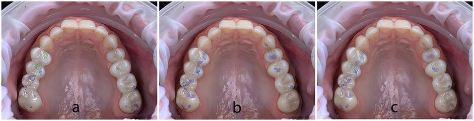 Three dental images labeled a, b, and c, show the occlusal marks on the upper teeth. Image a highlights bite marks on the left side, image b on the right side, and image c shows distribution on both sides.