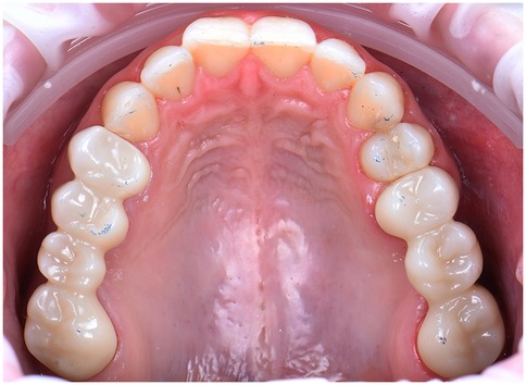 Close-up view of the upper dental arch showing healthy teeth and gums. Light blue ink stains are visible on the chewing surfaces, indicating possible dental impressions or bite marks.