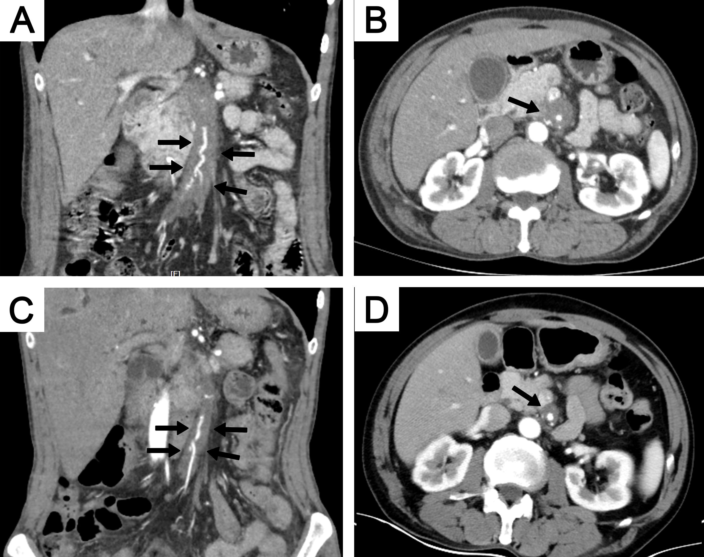 CT scans showing multiple panels. Panel A and C depict coronal views of the abdomen with arrows indicating structures in the abdominal cavity. Panel B and D show axial views, with an arrow marking a circular structure near the spine.