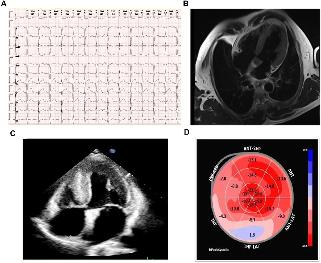 Panel A shows an electrocardiogram with multiple leads indicating heart activity. Panel B displays a chest MRI scan highlighting thoracic anatomy. Panel C is an echocardiogram showing a heart in cross-section. Panel D presents a polar plot with color gradients representing heart muscle strain values.