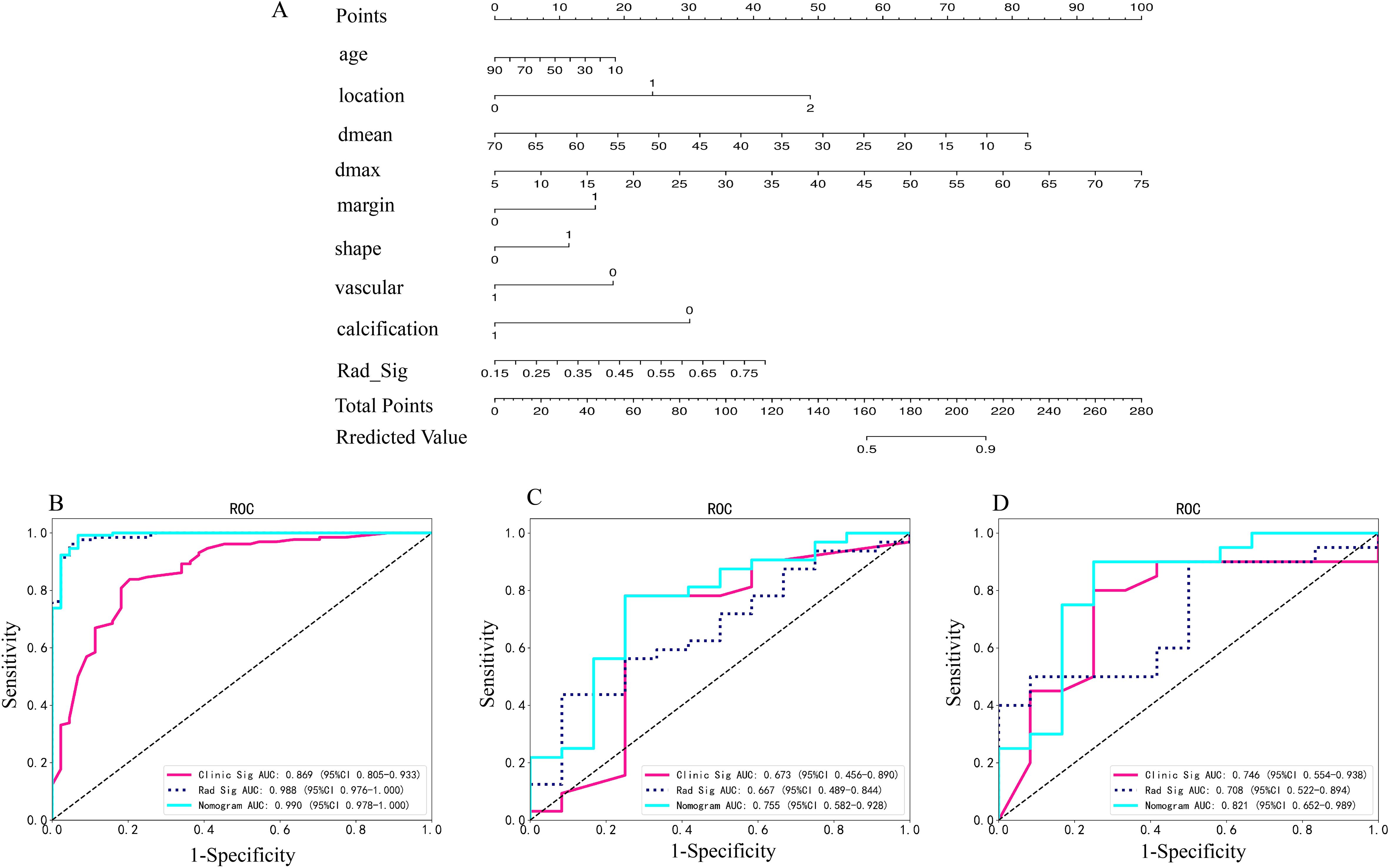 A composite image consisting of a nomogram in panel A that illustrates variables like age, location, and vascular points contributing to total points and predicted value. Panels B, C, and D display ROC curves showing sensitivity versus 1-specificity. Each panel includes lines for clinic signature, radiological signature, and a nomogram with respective AUC values: B (0.869, 0.988, 0.990), C (0.673, 0.667, 0.755), D (0.746, 0.708, 0.821). The ROC curves assess predictive performance.