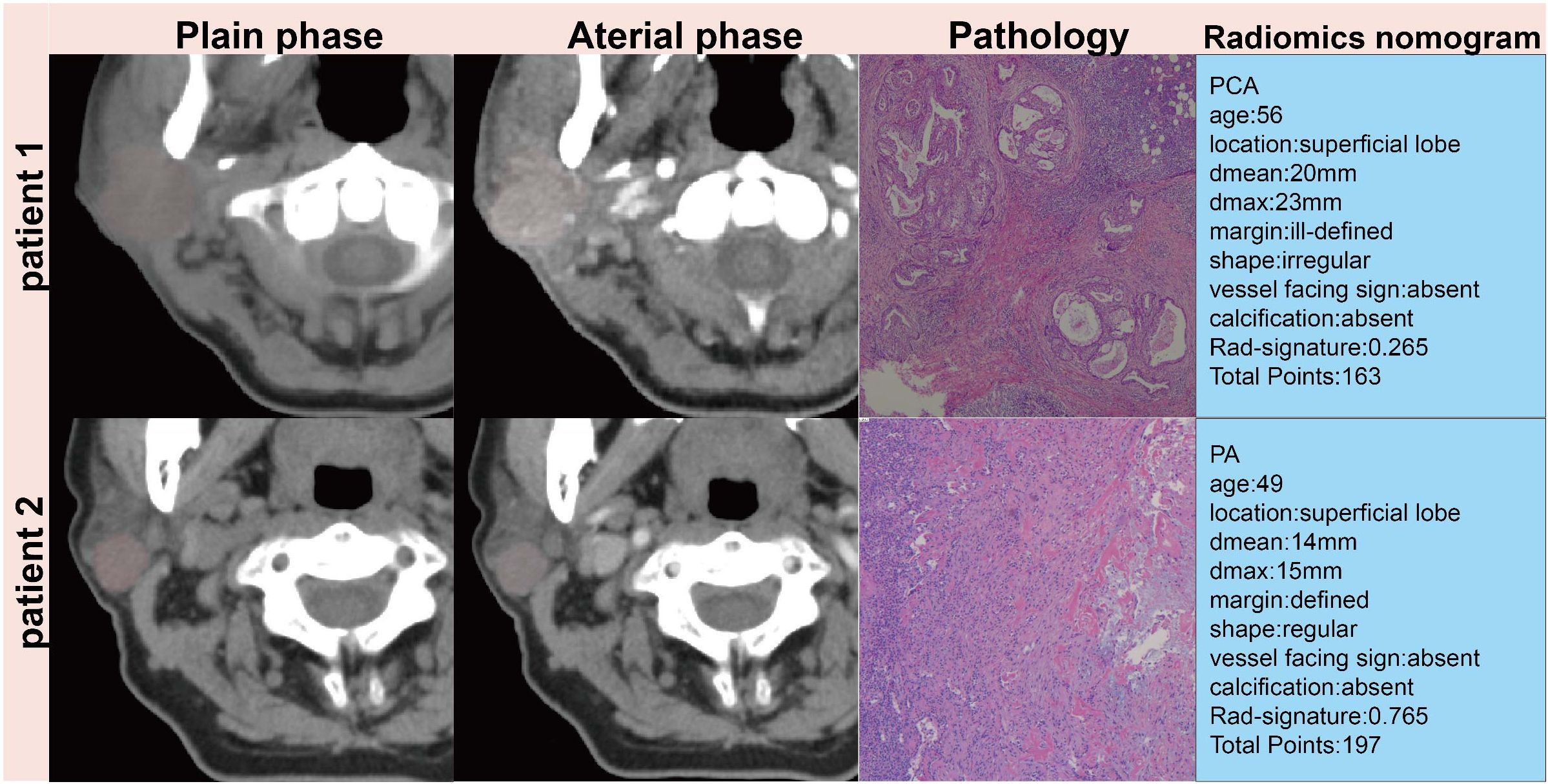 CT scans and pathology images for two patients, labeled “Patient 1” and “Patient 2,” show plain and arterial phases. Each includes a pathology image with details in a radiomics nomogram. Patient 1 has PCA, age 56, with irregular shape and ill-defined margin. Patient 2 has PA, age 49, with regular shape and defined margin. Both have absent vessel facing sign and calcification, with respective radiomics scores and total points.