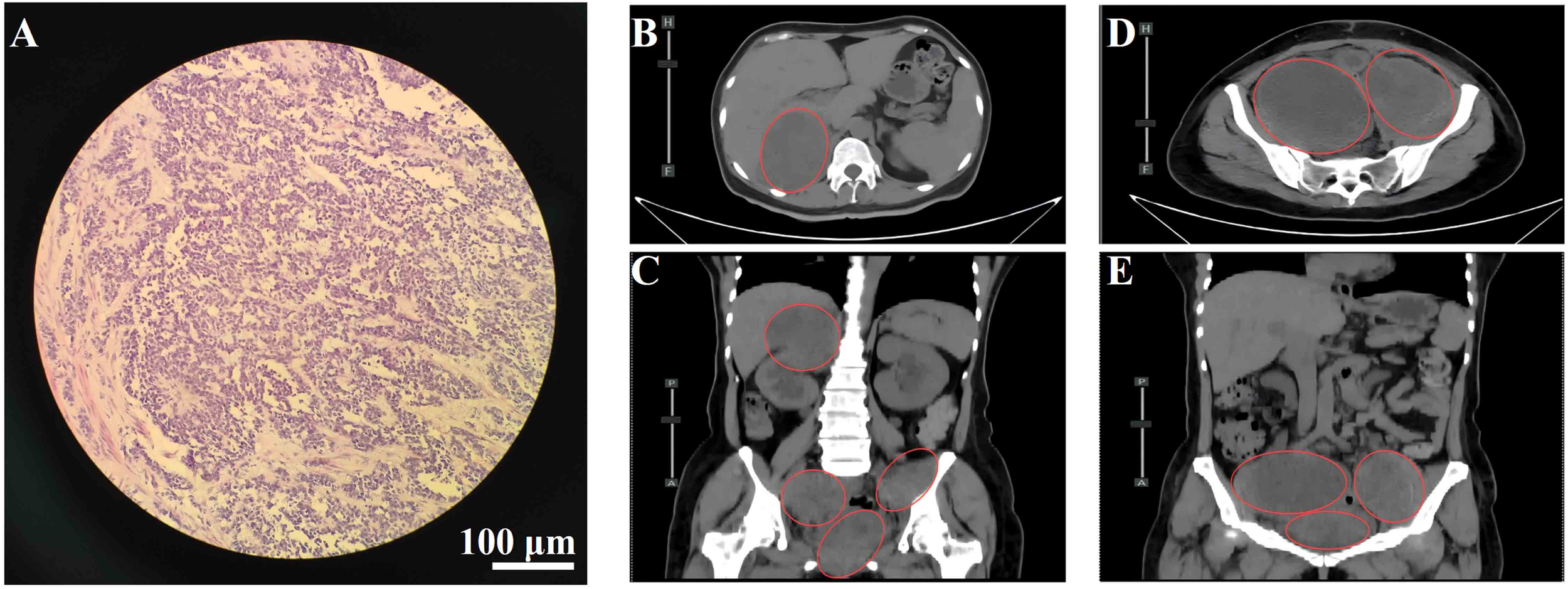 A series of medical images showing different views of a tissue sample and CT scans. Image A displays a microscopic view of the tissue, with fine granular details and a scale indicating 100 micrometers. Images B, C, D, and E are CT scans of the abdomen, highlighted with red circles indicating areas of interest, likely abnormal masses or organs. The scans are labeled with orientations such as axial (B, D) and coronal (C, E) views, showing cross-sections of the body.