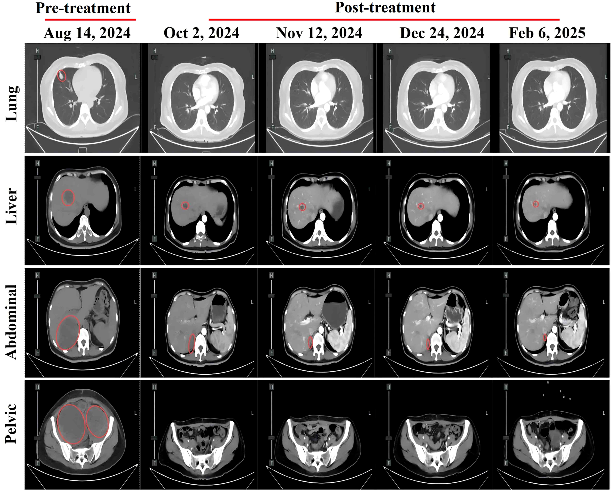CT scans show pre-treatment and post-treatment images of the lung, liver, abdominal, and pelvic regions from August 14, 2024, to February 6, 2025. Images illustrate changes over time, with regions marked in red for emphasis.