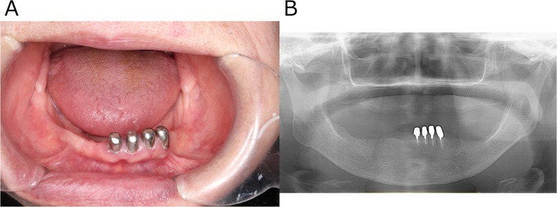 A dental image showing two panels: Panel A displays the interior of a mouth. Panel B is a panoramic X-ray which indicates no organic abnormality.