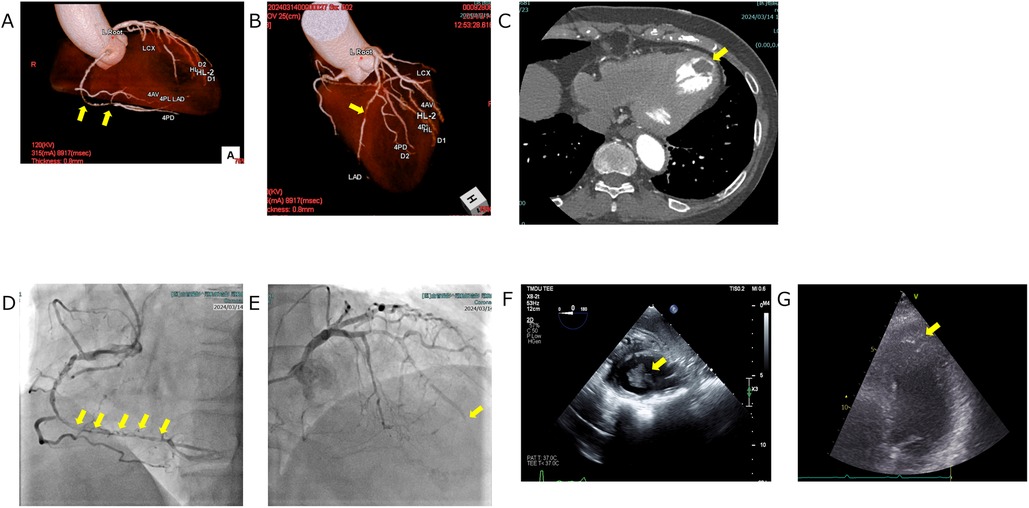 A series of medical images:\n\nA: 3D reconstruction of coronary arteries with arrows indicating specific locations.\n\nB: Another coronary artery 3D reconstruction with an arrow highlighting a different area.\n\nC: CT scan showing a cross-section of the chest with an arrow pointing to a spot on the heart.\n\nD: Angiogram of the coronary artery, with multiple arrows highlighting sections of the artery.\n\nE: Angiogram focusing on a different part of the coronary artery marked by an arrow.\n\nF: Echocardiogram with an arrow pointing to a specific heart structure.\n\nG: Another echocardiogram image with an arrow marking a distinct area of the heart.
