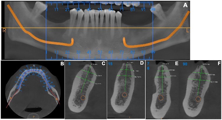 A composite image of dental X-rays and scans showing different views of a jaw. Panel A displays a panoramic X-ray with highlighted nerve pathways in orange. Panel B shows an axial view of the jaw with measurements. Panels C to F present cross-sectional images of individual sections of the jaw with various measurements in green, detailing distances and dimensions of anatomical structures.