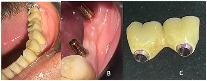 Panel A shows a side view of a dental prosthesis in place on the lower jaw. Panel B displays dental implants positioned in the gums without the prosthesis attached. Panel C features a close-up of a two-unit dental bridge with attachments.
