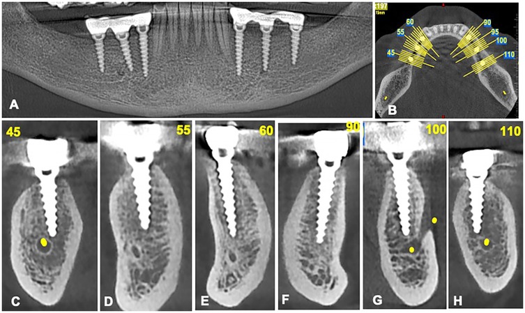 Dental imaging montage featuring multiple views of dental implants. Panel A shows a panoramic X-ray with implants in the jawbone. Panel B is an axial view with angles marked from 45 to 110 degrees. Panels C to H display cross-sectional images of implants with corresponding angle labels, highlighting bone integration and density variations. Yellow markers indicate points of interest.