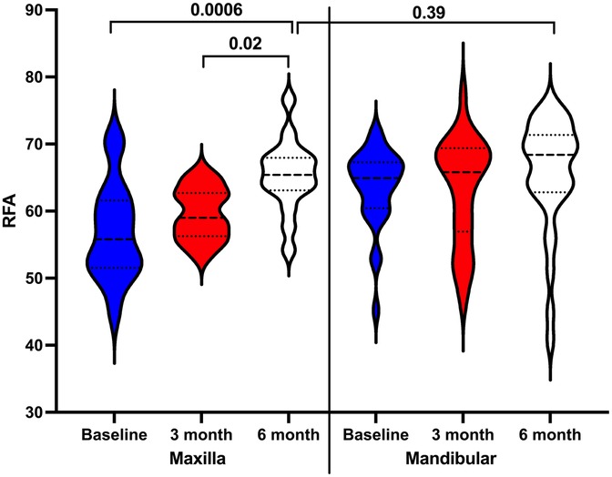 Violin plot showing RFA measurements over time for Maxilla and Mandibular implants. Maxilla data includes baseline, three months, and six months, with p-values of 0.0006 and 0.02. Mandibular data includes baseline, three months, and six months, with a p-value of 0.39. Each time point is displayed with distinct colors: blue for baseline, red for three months, and white for six months.