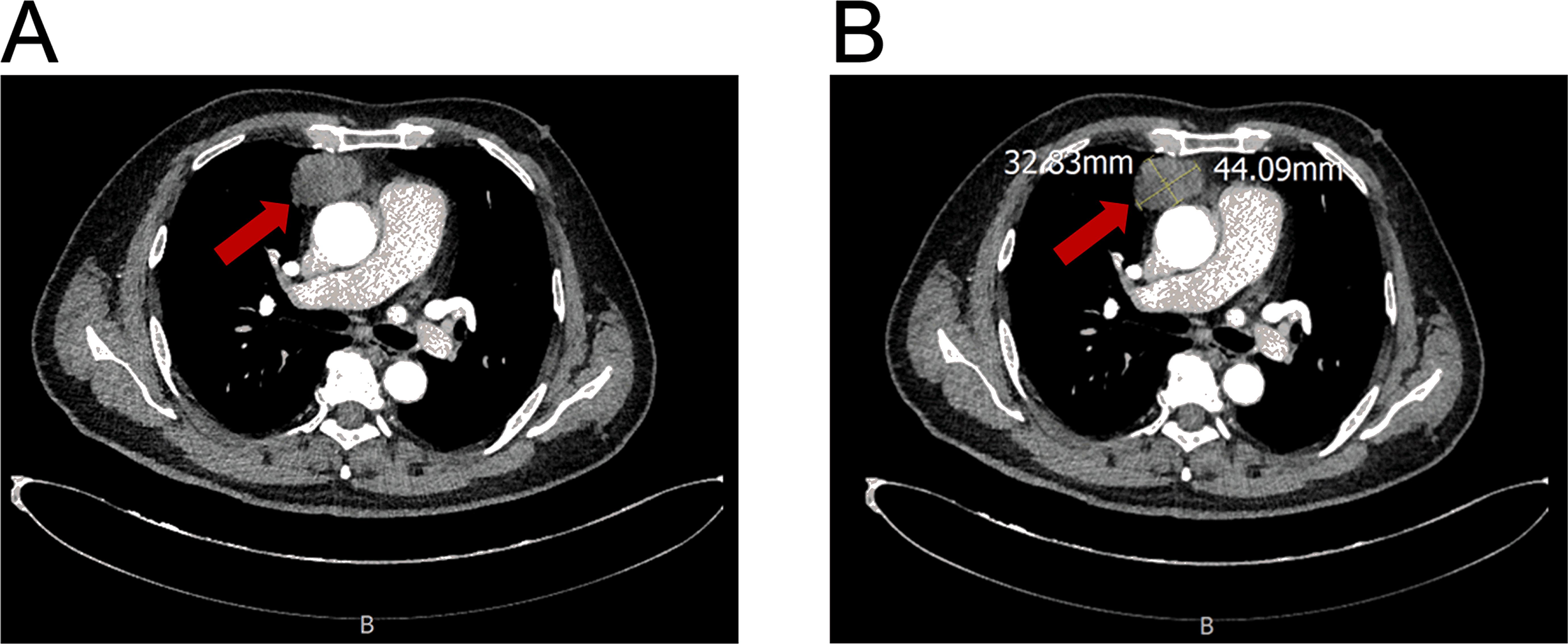 CT scan images labeled A and B show a cross-section of the chest, with red arrows pointing to a specific area. Image A highlights an area of interest, while image B includes measurements of 32.83 millimeters and 44.09 millimeters.