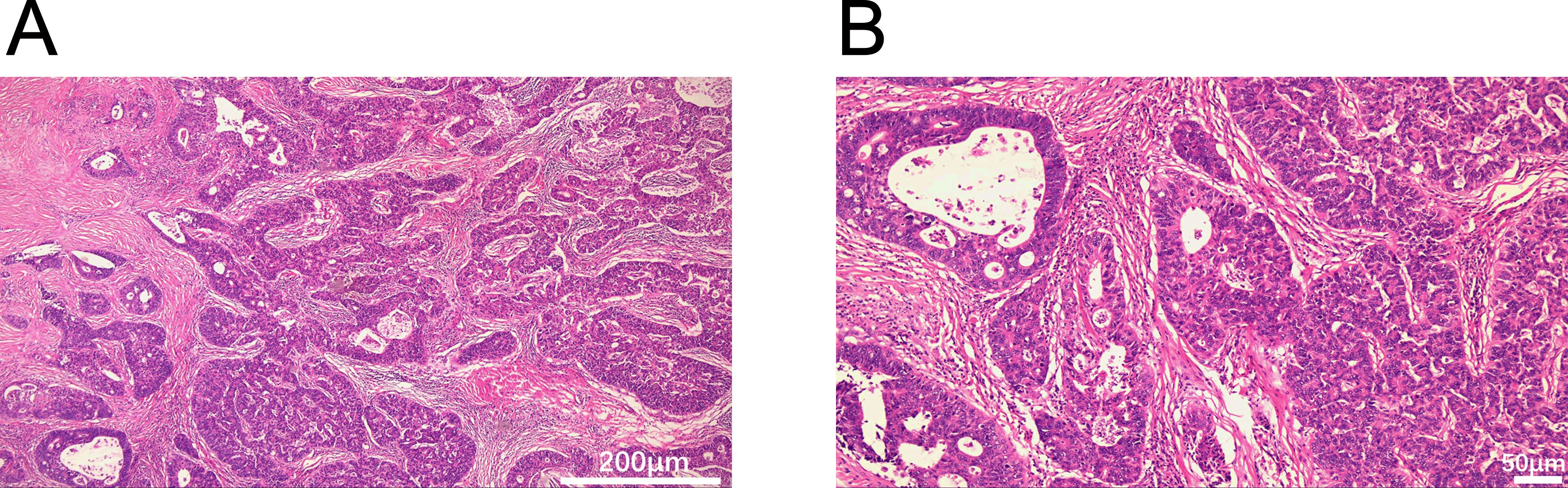 Histological comparison of two tissue samples stained with hematoxylin and eosin. Panel A shows less dense cellular structures with visible connective tissues and gland formations. Panel B displays denser cell populations with prominent glandular lumens. The scale for Panel A is 200 micrometers, and for Panel B is 50 micrometers.