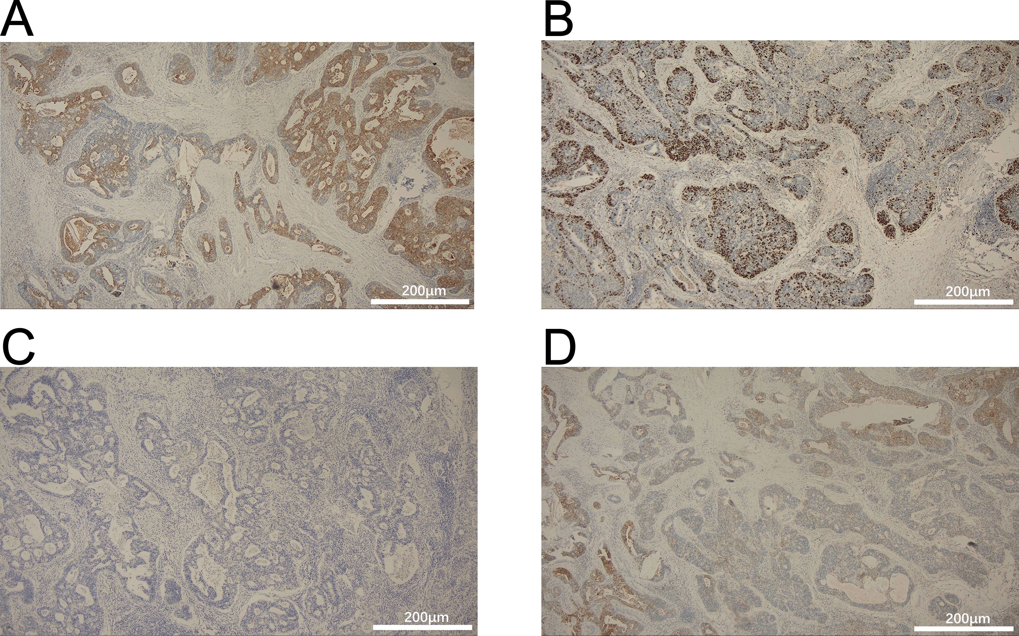 Histological images marked A, B, C, and D show tissue samples at a microscopic level. A, B, and D display varying densities of dark brown staining, indicating different levels of protein expression. C shows a lighter, less dense staining pattern. Each image includes a scale bar of two hundred micrometers.