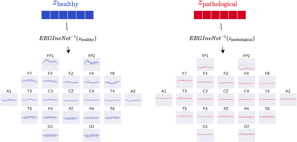 Diagram depicting EEG signals for healthy and pathological cases. On the left, labeled