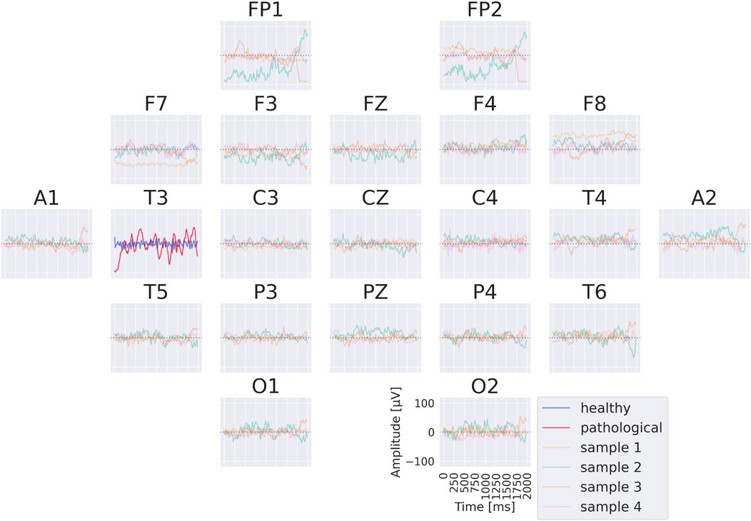 EEG plot showing different electrode positions labeled FP1, FP2, F7, F3, FZ, F4, F8, A1, T3, C3, CZ, C4, T4, A2, T5, P3, PZ, P4, T6, O1, O2. Each subplot contains line graphs comparing healthy and pathological signals, along with four sample datasets. The x-axis denotes time in milliseconds, and the y-axis represents amplitude in microvolts.