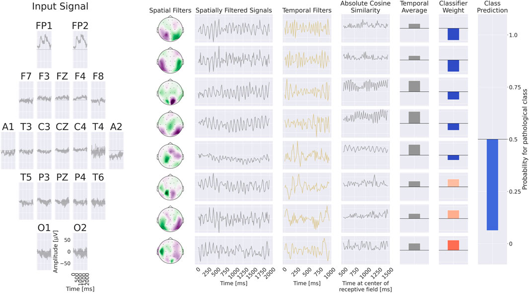 EEG signal processing visual, showing electrode data with graphs for spatially filtered signals, temporal filters, absolute cosine similarity, and temporal average. Classifier weights and class prediction display probability for pathological class, with highlighted bars in blue and gray.