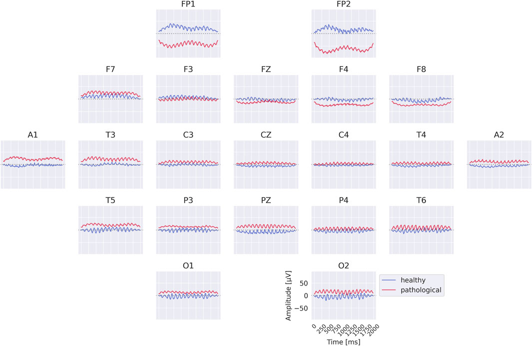 EEG waveform chart showing brain activity across 19 channels labeled FP1, FP2, F7, F3, FZ, F4, F8, A1, T3, C3, CZ, C4, T4, A2, T5, P3, PZ, P4, T6, O1, and O2. Each channel displays two lines representing healthy (blue) and pathological (red) signal amplitudes over a time period of zero to two thousand milliseconds. The Y-axis represents amplitude in microvolts.