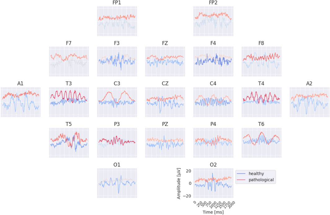 Electroencephalogram (EEG) plots arranged in a grid. Each plot shows two lines, blue for healthy and red for pathological signals, over time in milliseconds. Amplitude in microvolts is measured vertically. Plots are labeled with electrode positions: FP1, FP2, F7, F3, FZ, F4, F8, A1, T3, C3, CZ, C4, T4, A2, T5, P3, PZ, P4, T6, O1, and O2.