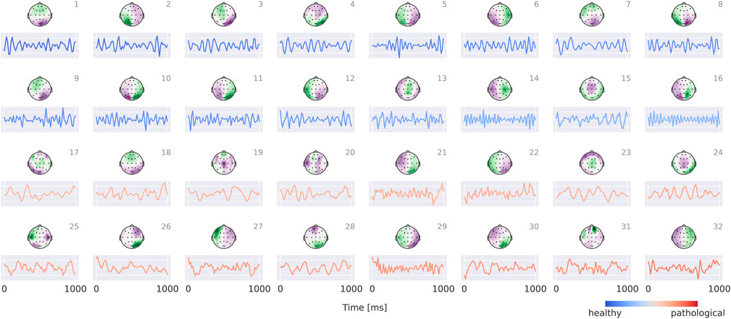 Electroencephalography (EEG) data visualization featuring 32 topographical head maps and corresponding time-series plots. The topographical maps, marked with numbers one to thirty-two, show brain activity differences, with color gradients indicating healthy (blue) to pathological (red) states. Below each map, line graphs display EEG waveforms over time in milliseconds. The top two rows have blue plots representing healthier activity, while the bottom two rows have red plots indicating more pathological patterns.