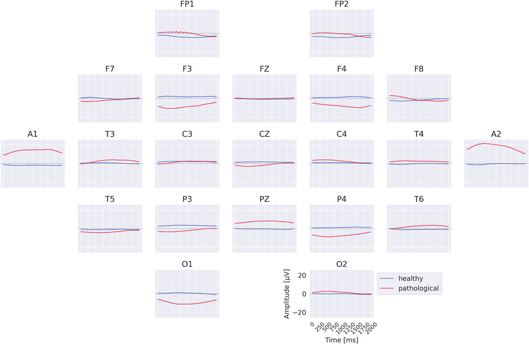 EEG waveform plots show brain activity from different electrode positions labeled FP1, FP2, F7, F3, FZ, F4, F8, A1, T3, C3, CZ, C4, T4, A2, T5, P3, PZ, P4, T6, O1, and O2. Each plot compares healthy (blue line) versus pathological (red line) brain wave activity. The x-axis represents time in milliseconds, and the y-axis shows amplitude in microvolts.