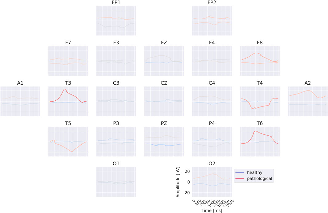 EEG montage with multiple electrode positions displaying waveform graphs. Each graph shows two lines: blue for healthy and red for pathological signals, indicating amplitude over time in milliseconds. The montage is labeled with electrode positions such as FP1, F7, T3, etc. The pathological line is prominent in T3 and T6 graphs.