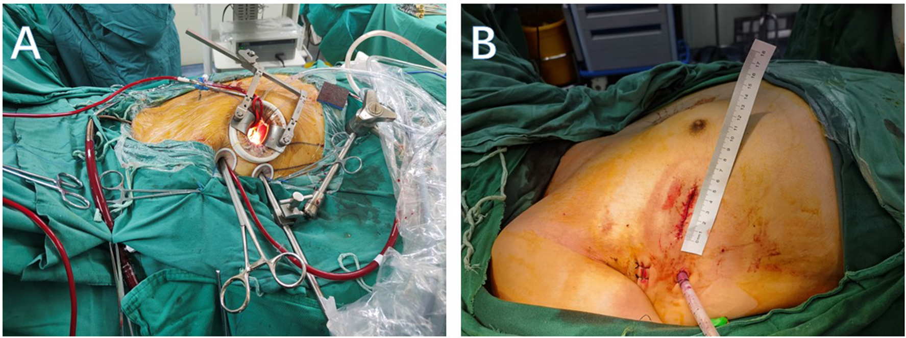 Panel A shows a surgical procedure with retractors and instruments positioned around an open incision, revealing internal tissues. Panel B displays the post-operative site with stitches and a ruler measuring the incision area.