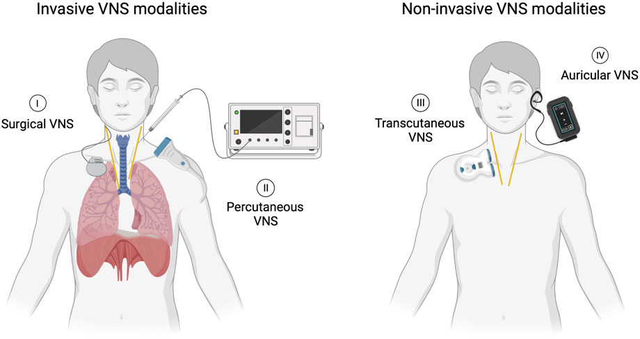 Illustration comparing invasive and non-invasive vagus nerve stimulation (VNS) modalities. The left side shows invasive methods: I. Surgical VNS with an implanted device and II. Percutaneous VNS using a needle connected to a machine. The right side depicts non-invasive methods: III. Transcutaneous VNS with electrodes on the neck, and IV. Auricular VNS, using an ear device attached to a handheld controller.