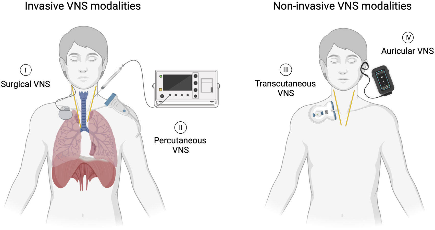 Illustration comparing invasive and non-invasive vagus nerve stimulation (VNS) modalities. The left side shows invasive methods: I. Surgical VNS with an implanted device and II. Percutaneous VNS using a needle connected to a machine. The right side depicts non-invasive methods: III. Transcutaneous VNS with electrodes on the neck, and IV. Auricular VNS, using an ear device attached to a handheld controller.