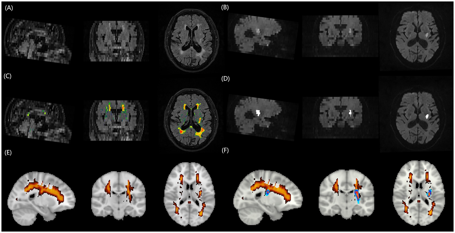 Six MRI brain imaging panels (A-F) demonstrating multimodal processing pipeline. Panel A shows FLAIR image with white matter hyperintensities. Panel B displays DWI revealing acute infarct. Panel C presents automated segmentation overlays on FLAIR image with highlighted white matter lesions. Panel D shows threshold segmentation results on DWI with infarct region marked. Panels E and F display three-dimensional renderings in standardized brain space, showing segmented white matter hyperintensities and infarct lesions respectively, with color-coded regions for spatial relationship visualization.