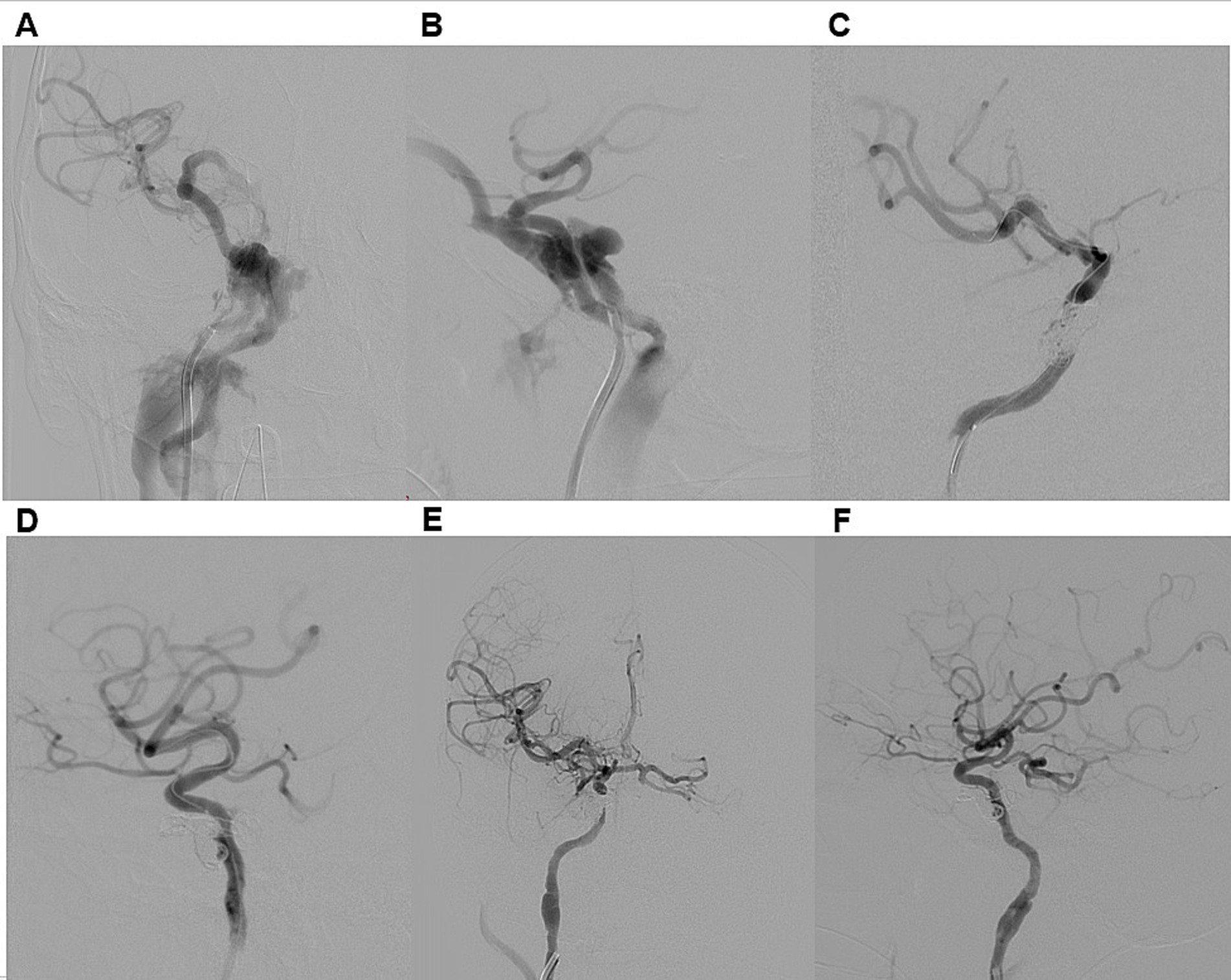 Angiographic images labeled A to F depict blood vessel formations. Panels A and B show dense clusters indicating possible vascular occlusions or abnormalities. Panel C displays fewer and finer vessels. Panel D shows a larger network with winding paths. Panels E and F illustrate complex branching patterns, likely indicating typical vascular structures within the brain. These images are likely used for medical analysis.