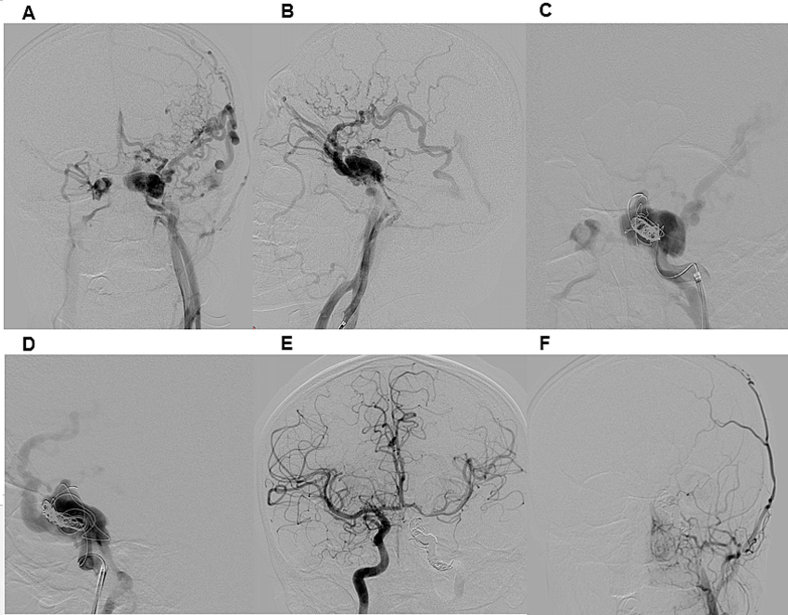 Angiographic images labeled A to F show various stages of cerebral angiography. Panels A and B illustrate blood vessels with aneurysms. Panels C and D display coiling of aneurysms. Panels E and F show improved post-treatment vessel flow.