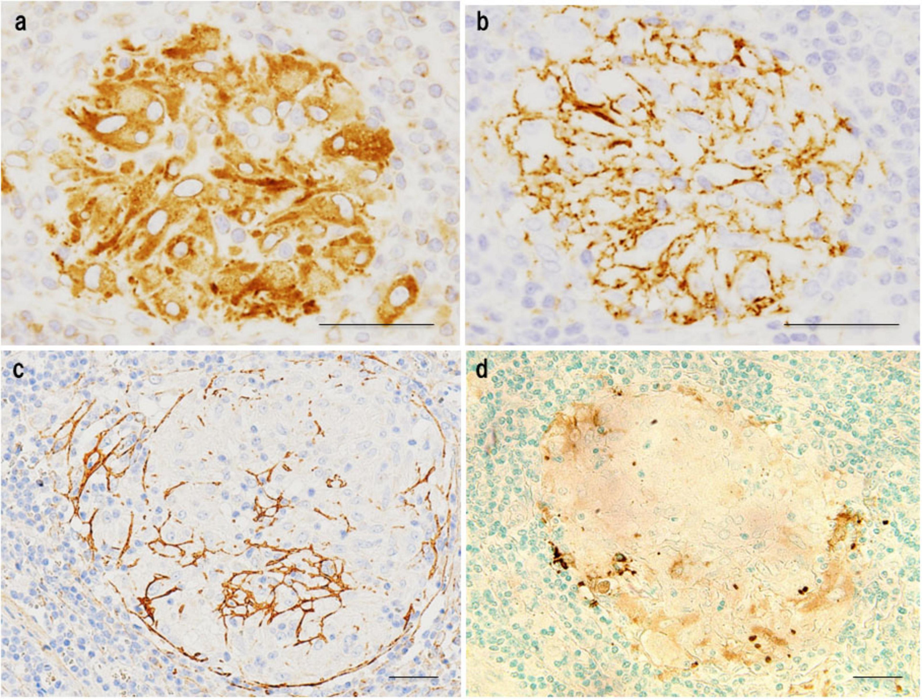 Four panels showing histological images of tissue samples. Panel a displays densely stained cellular clusters. Panel b shows a more fibrous stained pattern. Panel c presents a structure with a network-like appearance. Panel d features a large unstained area surrounded by stained cells. Each panel has a different staining intensity and pattern.