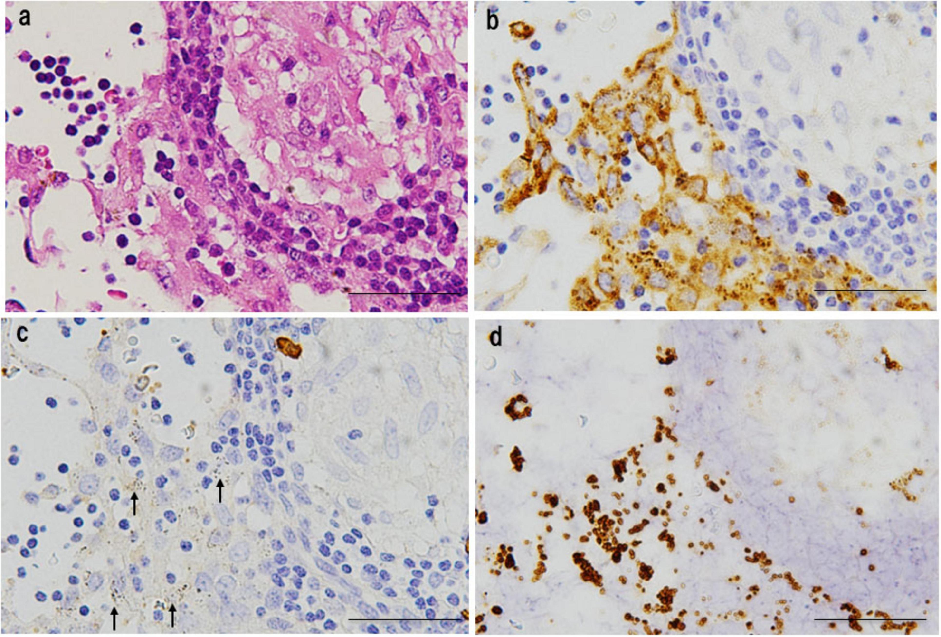 Histological images showing tissue samples. Panel (a) displays a hematoxylin and eosin stain with pink and purple hues. Panel (b) shows brown staining indicating protein presence. Panel (c) highlights specific cells marked by arrows. Panel (d) shows brown-stained clusters against a pale background.