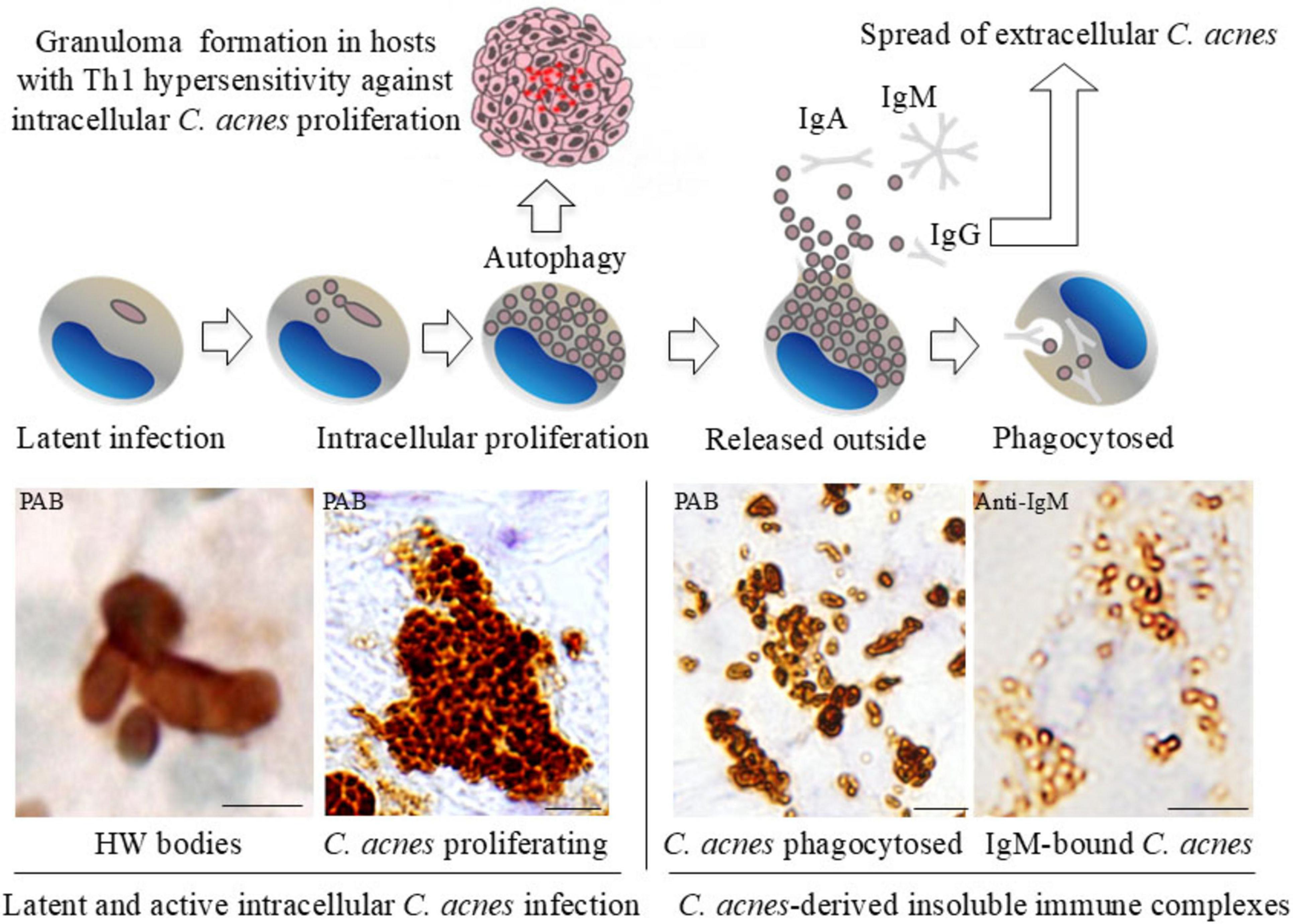 Illustration showing the process of C. acnes infection. It begins with latent infection, progresses through intracellular proliferation, and releases outside, where it is phagocytosed. The top diagram shows granuloma formation and the immune response involving IgA, IgM, and IgG. The bottom includes four micrographs: HW bodies, proliferating C. acnes, phagocytosed C. acnes, and IgM-bound C. acnes. The images depict the stages of infection and immune interaction.