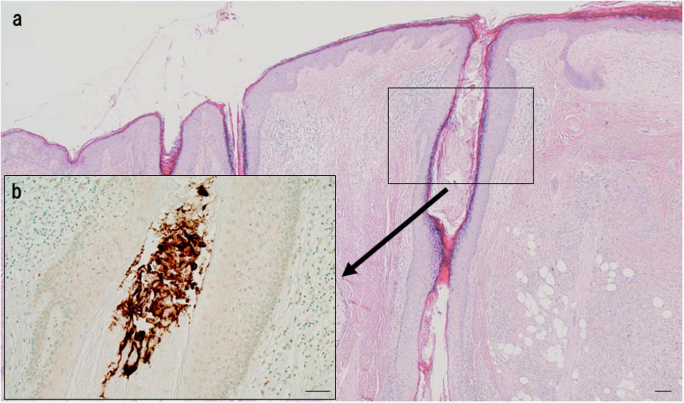 Histological slide showing a section of skin tissue with two panels. The main panel (a) displays the overall tissue structure, stained in pink and purple, highlighting layers and a hair follicle. The inset (b) is a zoomed-in area outlined by a box and indicated with an arrow, showing a detailed view of cells with brown pigmentation, likely melanin.