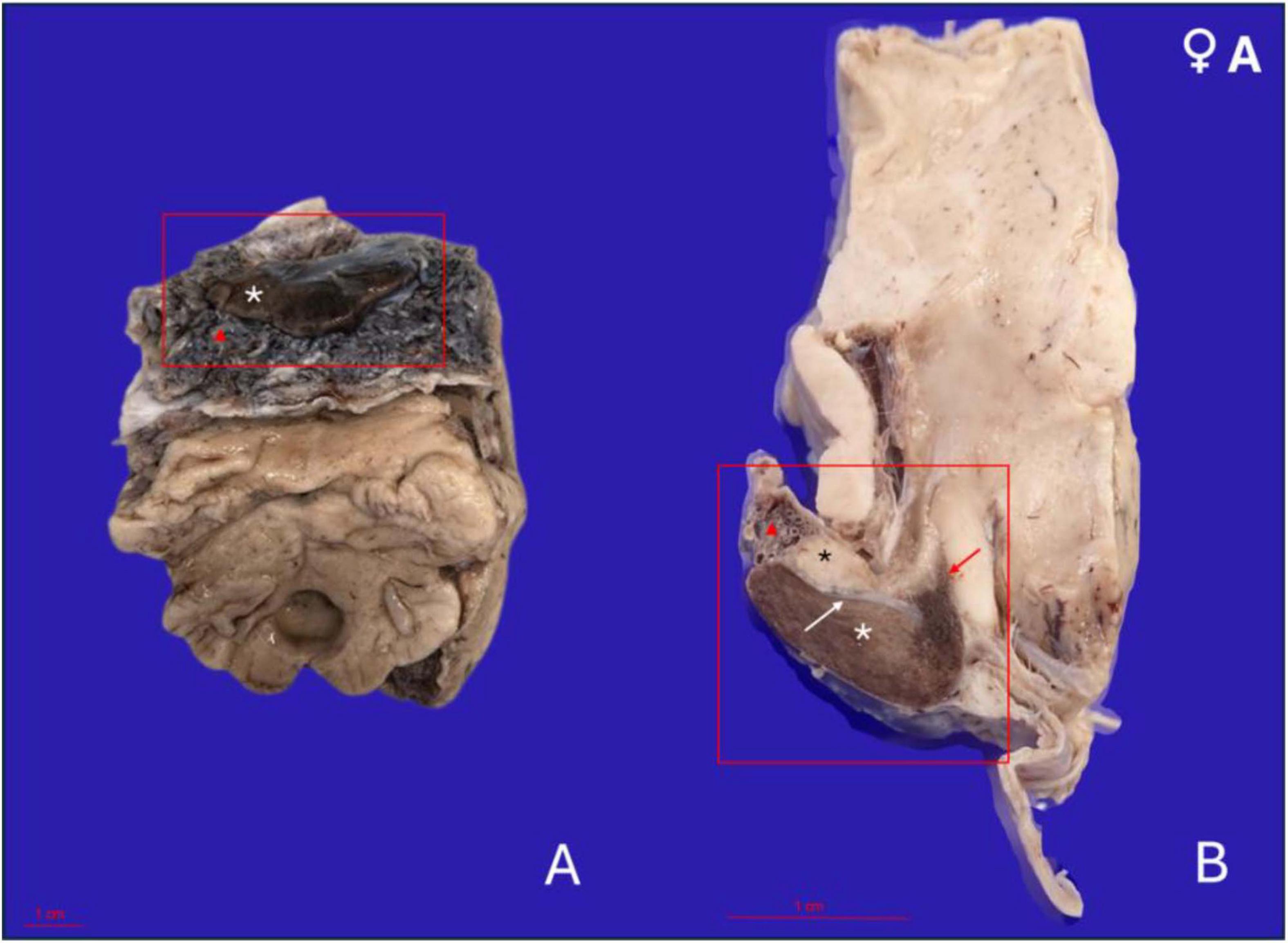 Gross anatomical images of the dissected pituitary gland of a 17-year-old female orca on a blue background. Panel A shows a caudoventral view of the gland in situ, attached to brain tissue, with the adenohypophysis highlighted by a white asterisk and embedded in a vascularized pad (red triangle). Panel B shows a midsagittal section with the larger adenohypophysis (white asterisk) ventrally and the smaller neurohypophysis (black asterisk) dorsocaudally, connected to the hypothalamus by the infundibulum (red arrow). The fibrous dural recess is visible (white arrow).