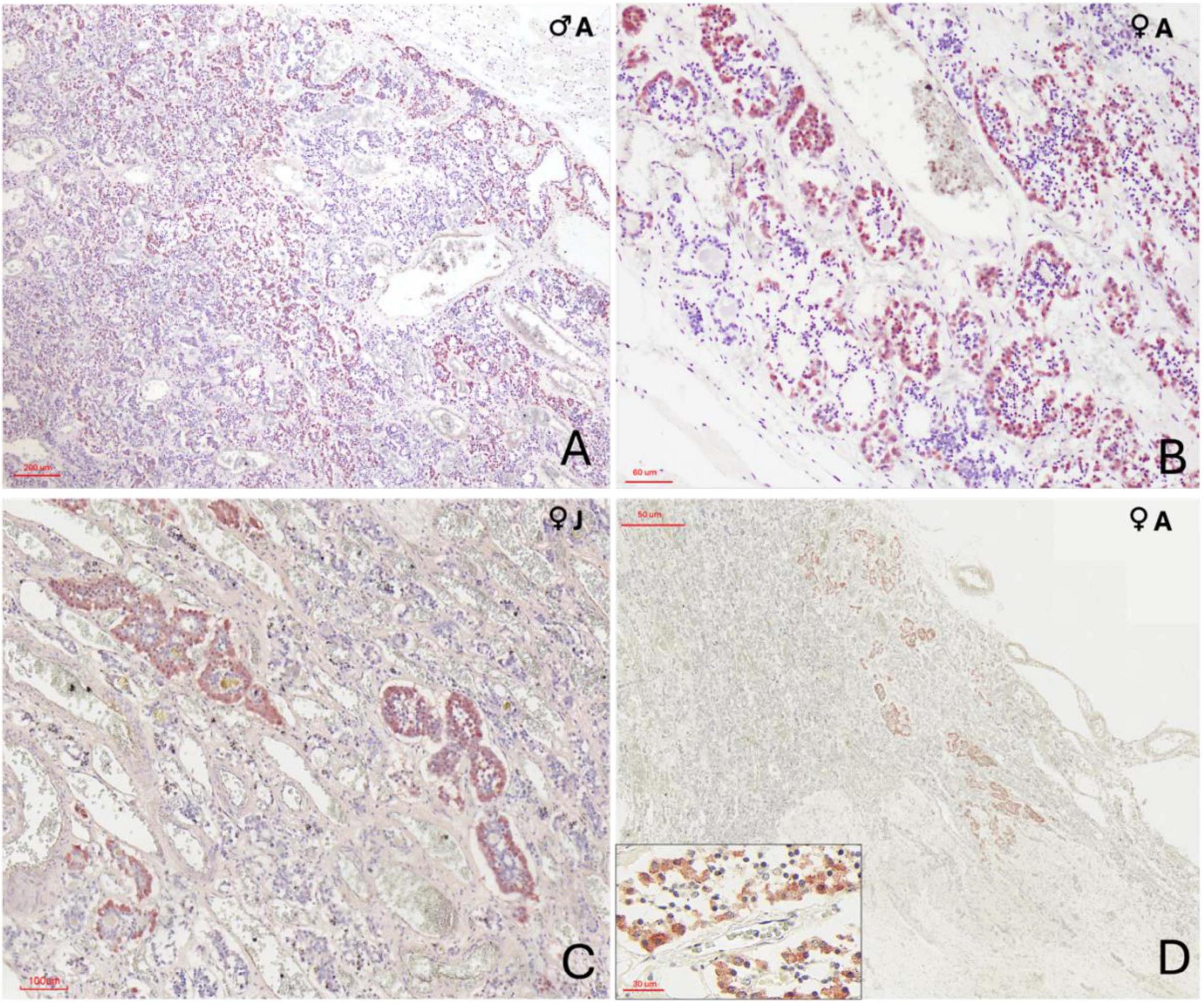 Immunohistochemical images of adenohypophyseal cells stained with anti-ACTH antibody in orcas. Panel A shows adult male tissue with ACTH-positive cells dispersed or in rosettes. Panel B shows ACTH-positive rosettes in adult female pars tuberalis near capillaries. Panel C depicts a juvenile female with rosette arrangements at the pars distalis and tuberalis junction. Panel D shows fewer ACTH-positive cells organized in rosettes near the neuroendocrine interface, with an inset revealing polygonal cell morphology and distinct cytoplasmic boundaries.