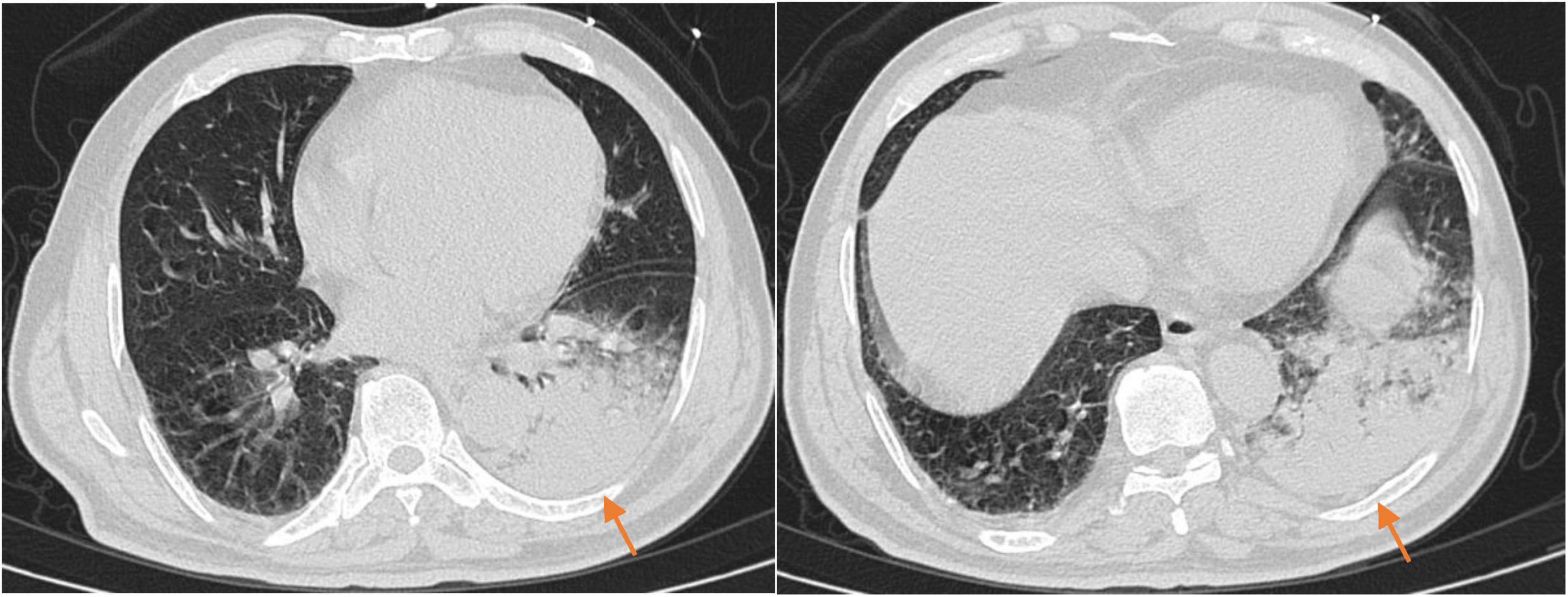 CT scan images show two cross-sectional views of a chest. The left image displays irregular opacities in the lung, and the right image shows a similar pattern with two arrows indicating areas of interest.