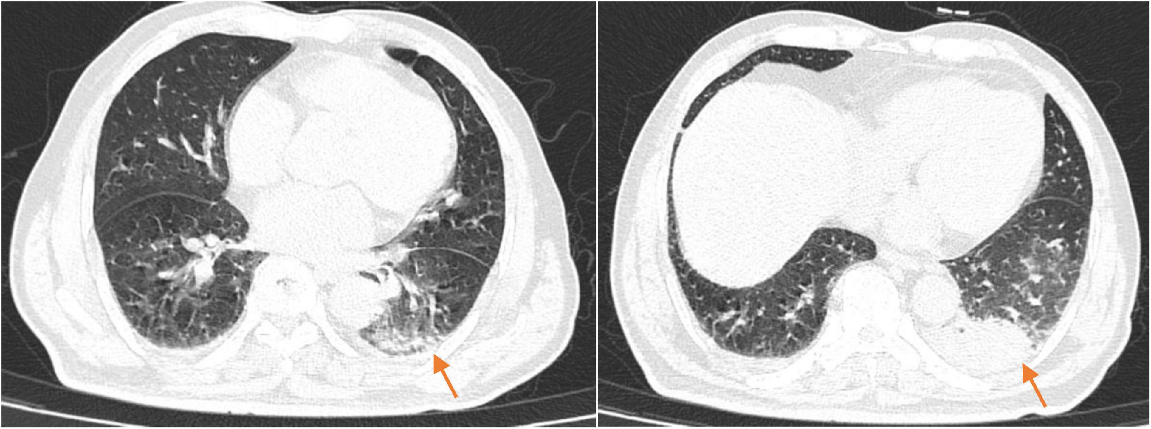 Two chest CT scan images are shown side by side. Both scans display lung areas with varying opacity. Arrows point to regions in the lower lung lobes, indicating areas of notable interest that may suggest abnormalities or fluid accumulation.
