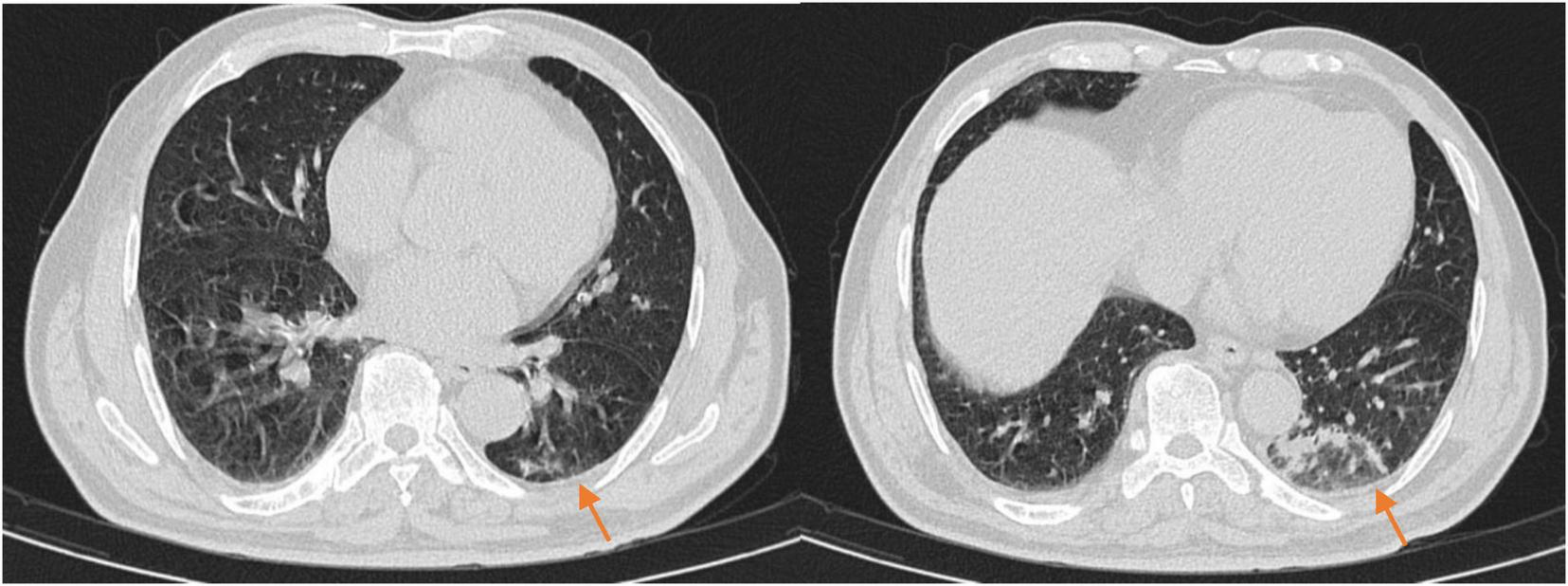Two chest CT scan images showing cross-sectional views of the lungs. Both images have arrows pointing to areas of concern in the lower regions of the lungs, indicating abnormalities possibly consistent with a medical condition.