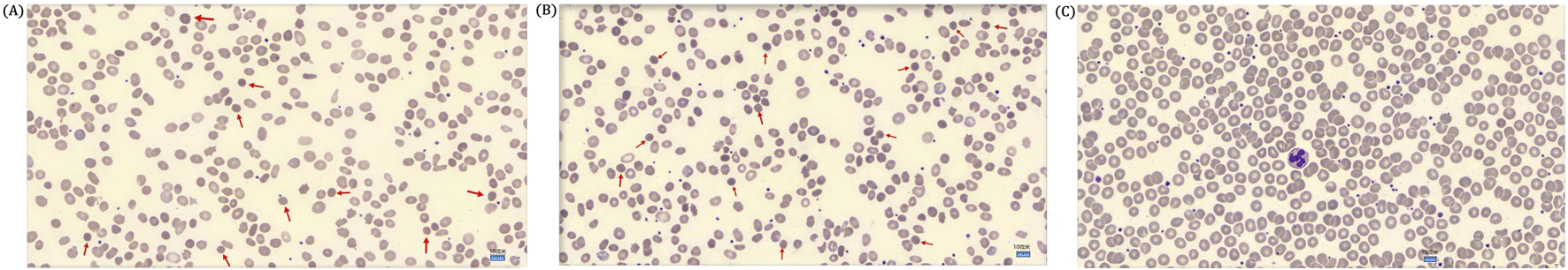 Three panels of blood smear images labeled (A), (B), and (C). Panel (A) and (B) show numerous oval-shaped cells with some highlighted by red arrows, indicating abnormalities. Panel (C) displays similar cells but includes a prominent purple-stained cell in the center.