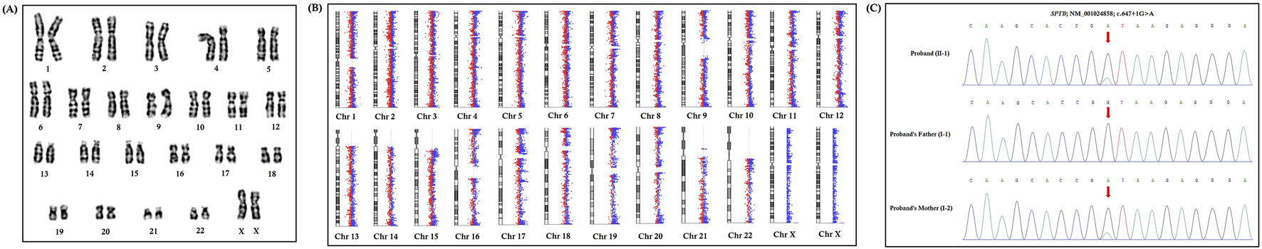 (A) Karyotype showing 23 pairs of chromosomes, including XX sex chromosomes, indicating a female. (B) Chromosomal microarray data for chromosomes one to twenty-two and X, with plots showing genetic variation in blue and red. (C) Sequencing data with genetic variation identified at c.647+1G>A in SPTB gene, shown for the proband and both parents, with red arrows indicating mutation points.