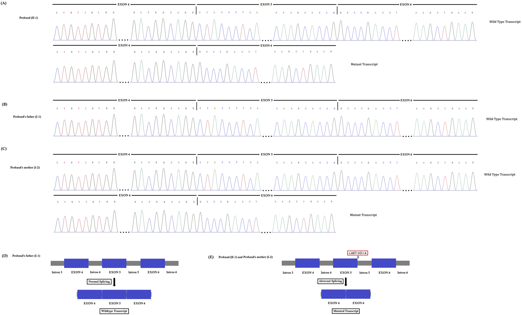 Genetic sequencing chromatograms and diagrams illustrate exon and intron regions, highlighting wild-type and mutant transcripts. Panel A shows the proband's sequencing with both transcripts. Panels B and C depict the parents' sequencing with wild-type transcripts. Panel D illustrates normal splicing in the proband’s father, while Panel E shows aberrant splicing and mutation in the proband and mother. The mutation point is marked as c.647+1G>A.