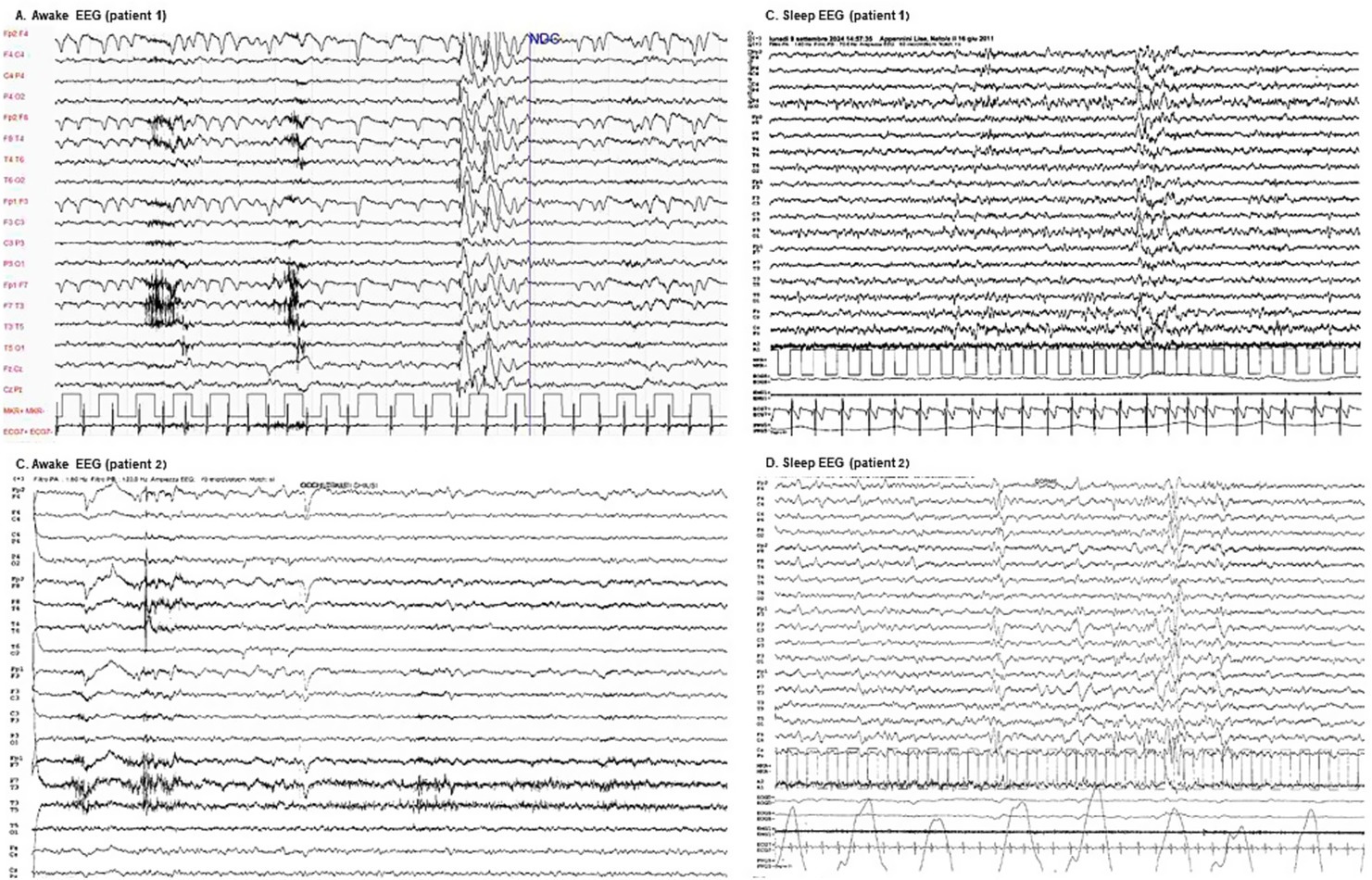 Four EEG graphs showing brain activity patterns. Top left: Awake EEG for patient 1, showing varied amplitude and frequency. Top right: Sleep EEG for patient 1, with different wave patterns. Bottom left: Awake EEG for patient 2, with distinct signal changes. Bottom right: Sleep EEG for patient 2, displaying unique sleep-related waveform characteristics.