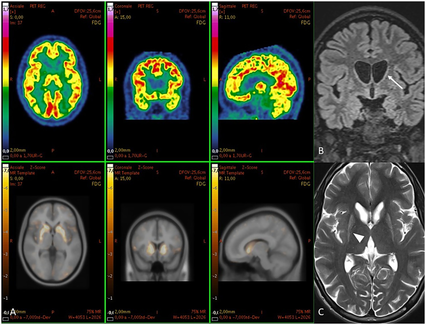 Medical imaging series showing brain scans. Top row displays PET scans with color variations indicating different activity levels. Bottom row includes MRI images, with the left image labeled B showing a black and white brain cross-section with an arrow pointing to a specific area, and the right image labeled C showing another black and white cross-section with a triangular marker. Each scan shows different aspects of the brain's structure and function.