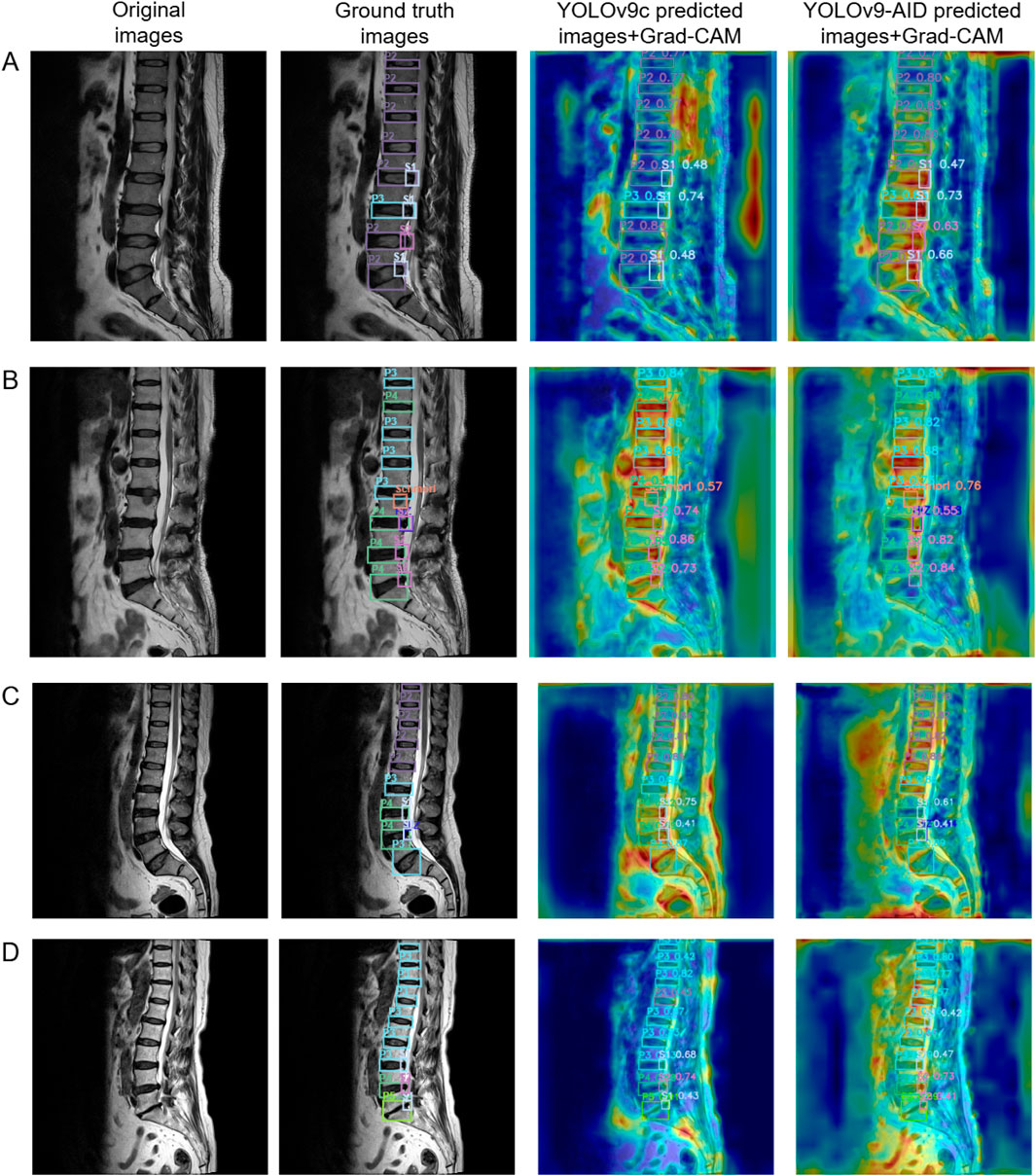 MRI scans of the spine in four rows labeled A to D show different analysis stages. The first column features original images, the second column displays ground truth images with annotated markers, and the last two columns illustrate predicted outcomes using YOLOv9c and YOLOv9-AID models with Grad-CAM, highlighting heatmaps and prediction values.