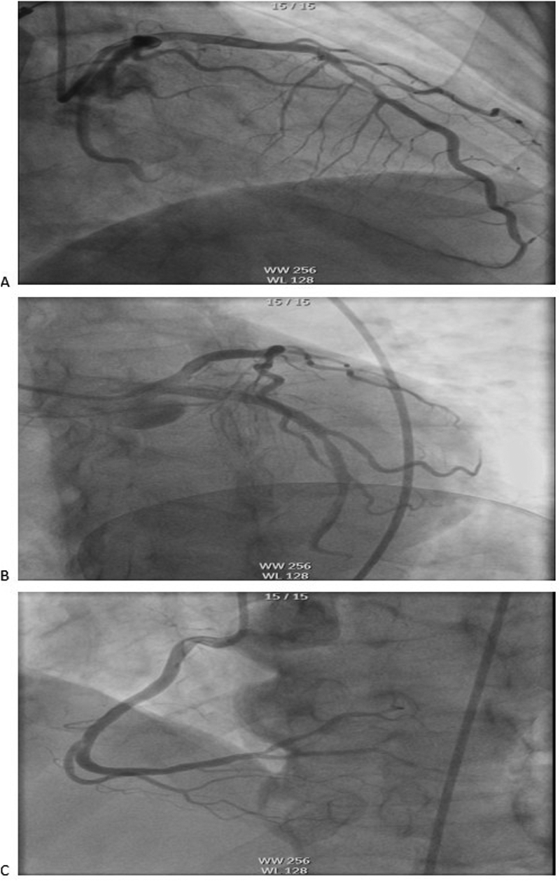 Emergent coronary angiography demonstrated no significant stenosis in the three major coronary vessels: (A) LAD; (B) LCX; (C) RCA. LAD, the left anterior descending artery ; LCX, left circumflex artery; RCA, right coronary artery.